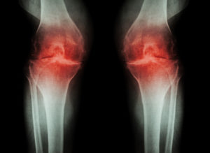 xray of osteoarthritis in knees
