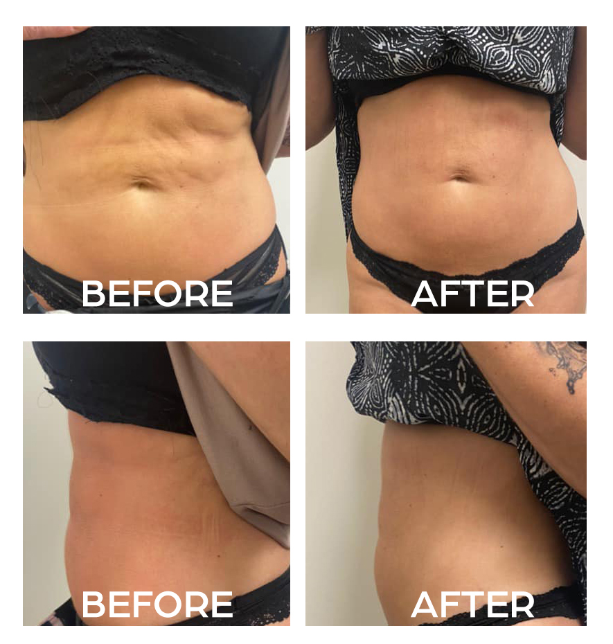 Body Contouring Before and After, Real Results