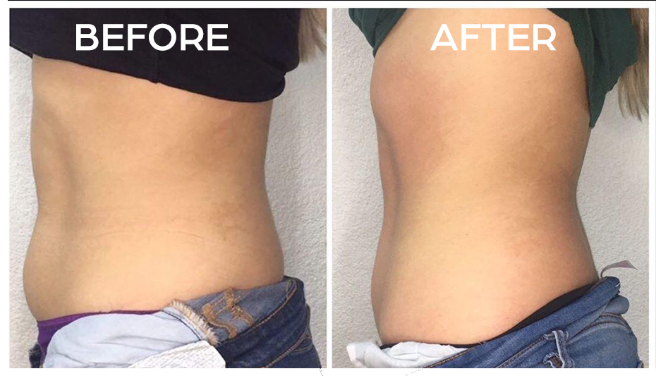 Clark NJ Cryo Body Fat Loss